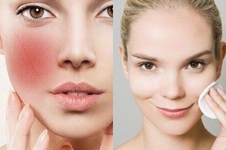 角质层薄,脸上有红血丝,应该要用什么护肤品来保养呢?