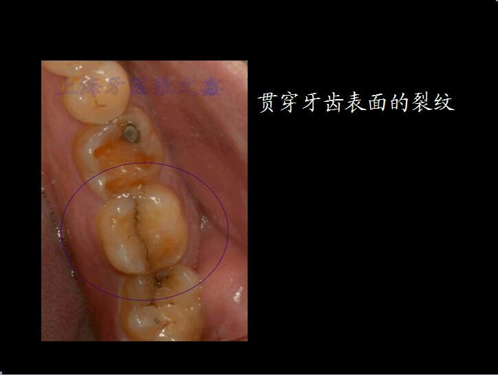 牙隐裂|牙隐裂|裂纹|牙尖