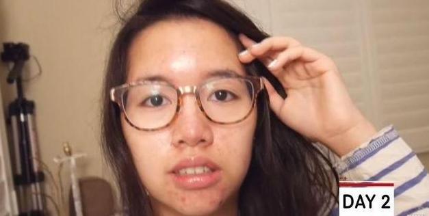 女生脸部干燥长痘,每天坚持喝2000cc开水,1周