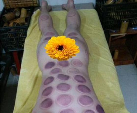 脚底拔罐到底好不好?有5种人千万别去拔罐!