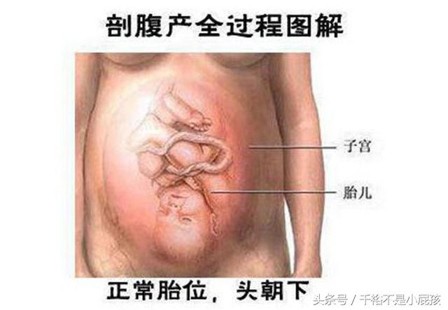 女人剖腹产生孩子,一步步"图解"!看完真心疼老婆!