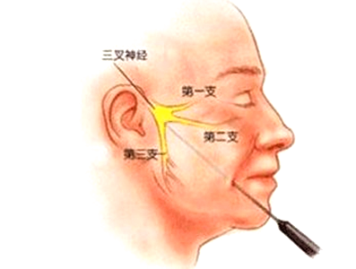 扳机点--你不知道的那些痛(附图文解析、表格总结)