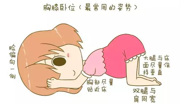 如果出现了胎位不正,孕妇可以采用"胸膝卧位"的方式,孕妈妈采取跪伏