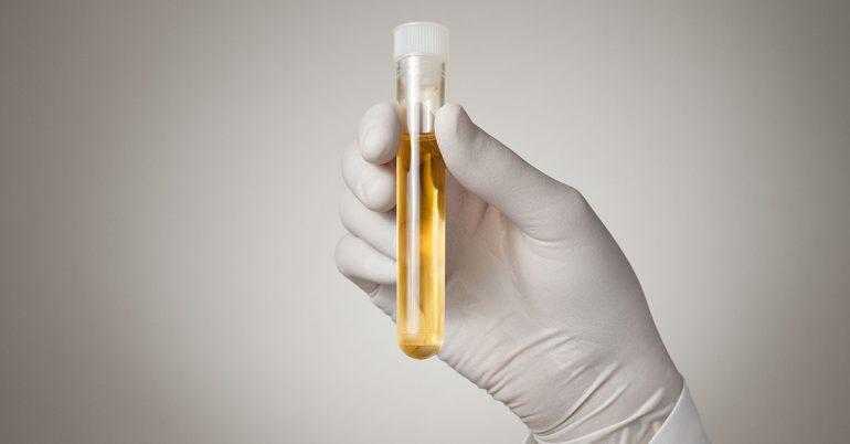 女人千万别把尿液变色不当回事儿,很有可能是