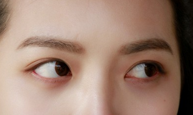 细纹是女人的天敌,如果我们的眼睛皱纹都是细纹,那么就会让女人的容颜
