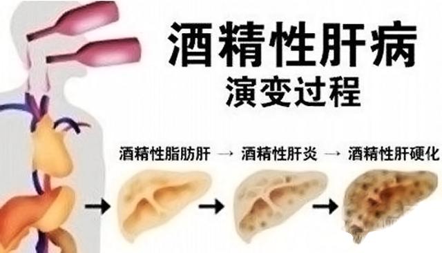 酒精肝为何如此致命?...
