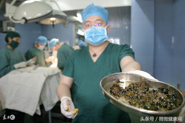 科医生:刷牙也去不掉口臭,八成是这里已长满结石