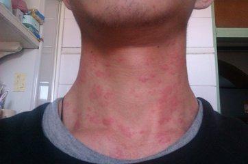 荨麻疹是怎么一回事,用一个红色的东西,可止痒
