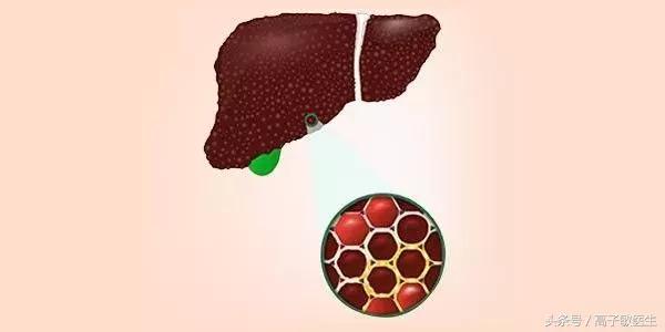 有小三阳但肝功能正常,为什么还会肝硬化?