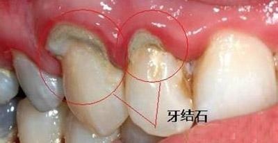 这么大块的牙结石掉了可咋办?牙结石反反复复有,教你三招去除!