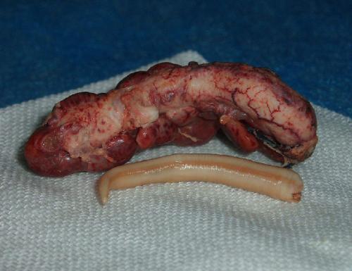 28岁的她右小腹突然疼痛还以为是宫缩