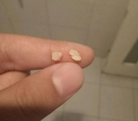扁桃体发炎,出现这个症状就要特别注意了!