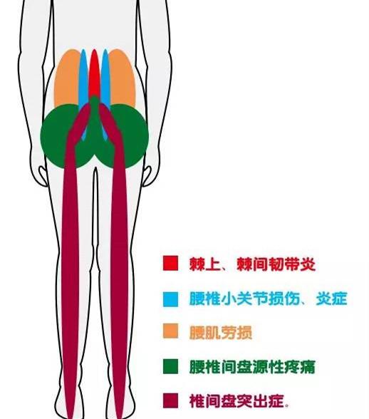 籽顶10副药,专治腰疼,用一个好一个,家有腰椎疼