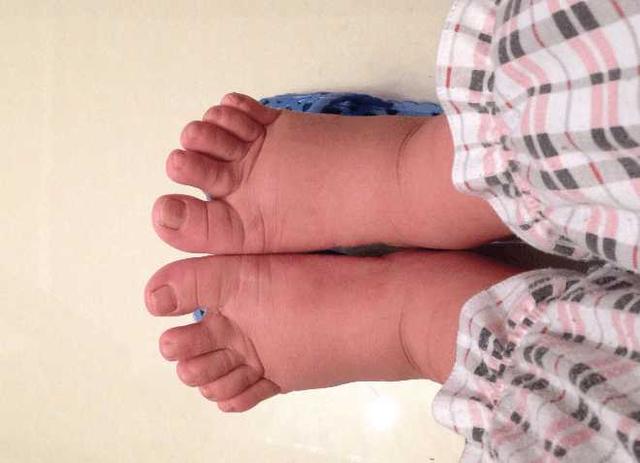 1岁宝宝的脚一碰就哭,医生检查后取出的这东西