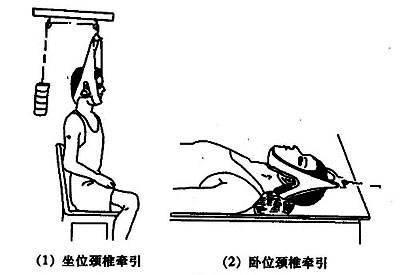 颈椎病不治疗后果不堪