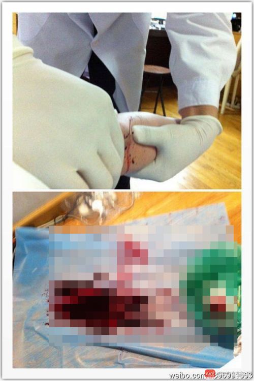 放血疗法仍被用于治病 专家:对大部分病症无疗效