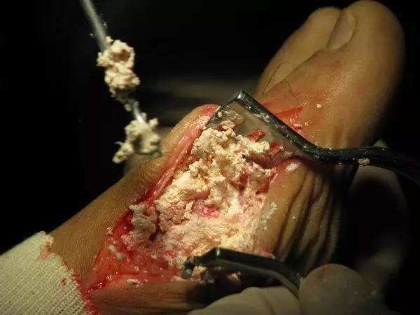 痛风男子吃别嘌醇片半年死亡,出现这些情况,痛