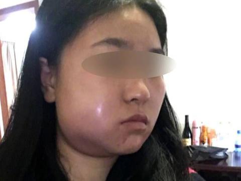 杭州姑娘拔了智齿 脸肿得像"鹅蛋"[允悲]
