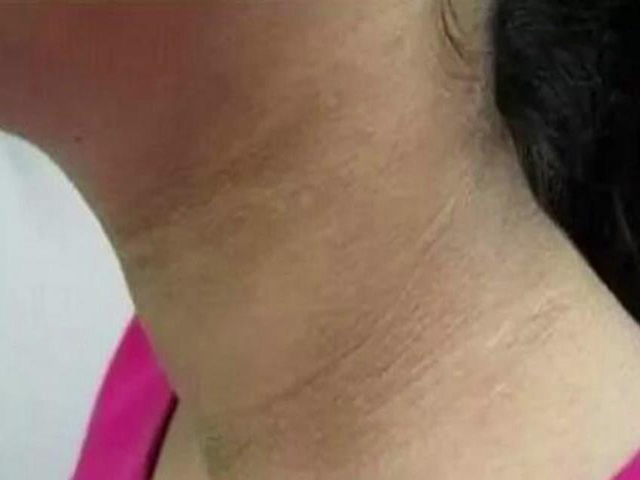 经过一项一项地排查,最终确定是由于肥胖引起的,叫做假性黑棘皮病的一