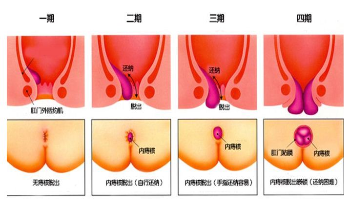 痔疮垫什么原理_轻微的痔疮长什么样子(2)