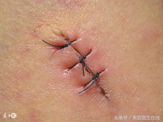 生产时,自然撕裂与侧切有什么不同?妇科医生站出来为