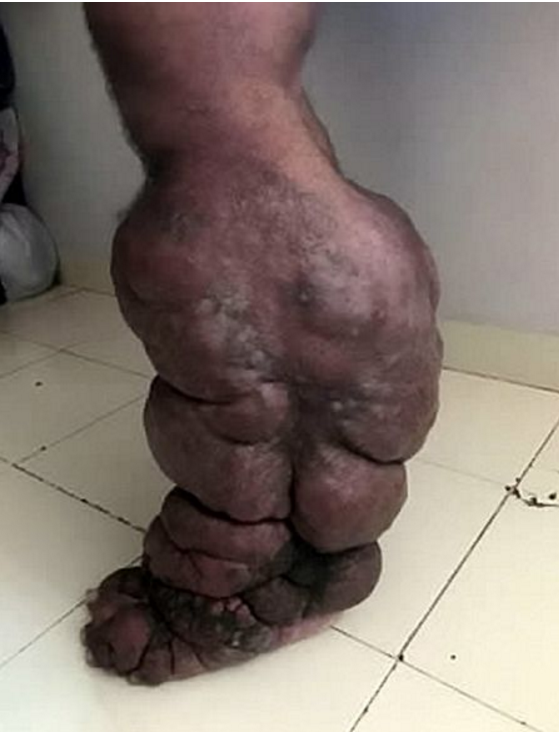 男子野外作业被蚊子叮,一条腿肿得像大象腿,野外工作