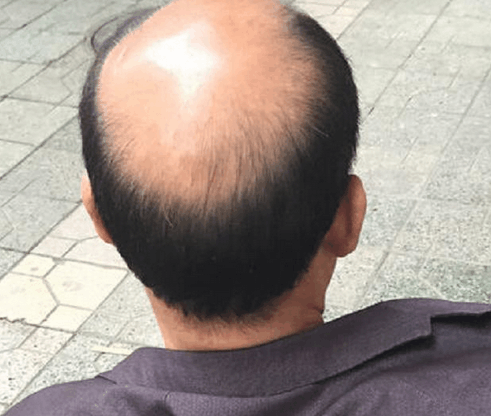 如果秃顶就这样梳头, 至今仍在使用|发型|男人|头发_新浪新闻