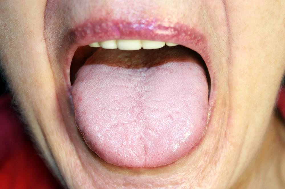 口腔科医生: 舌头变白, 小心这些病, 其中包含艾