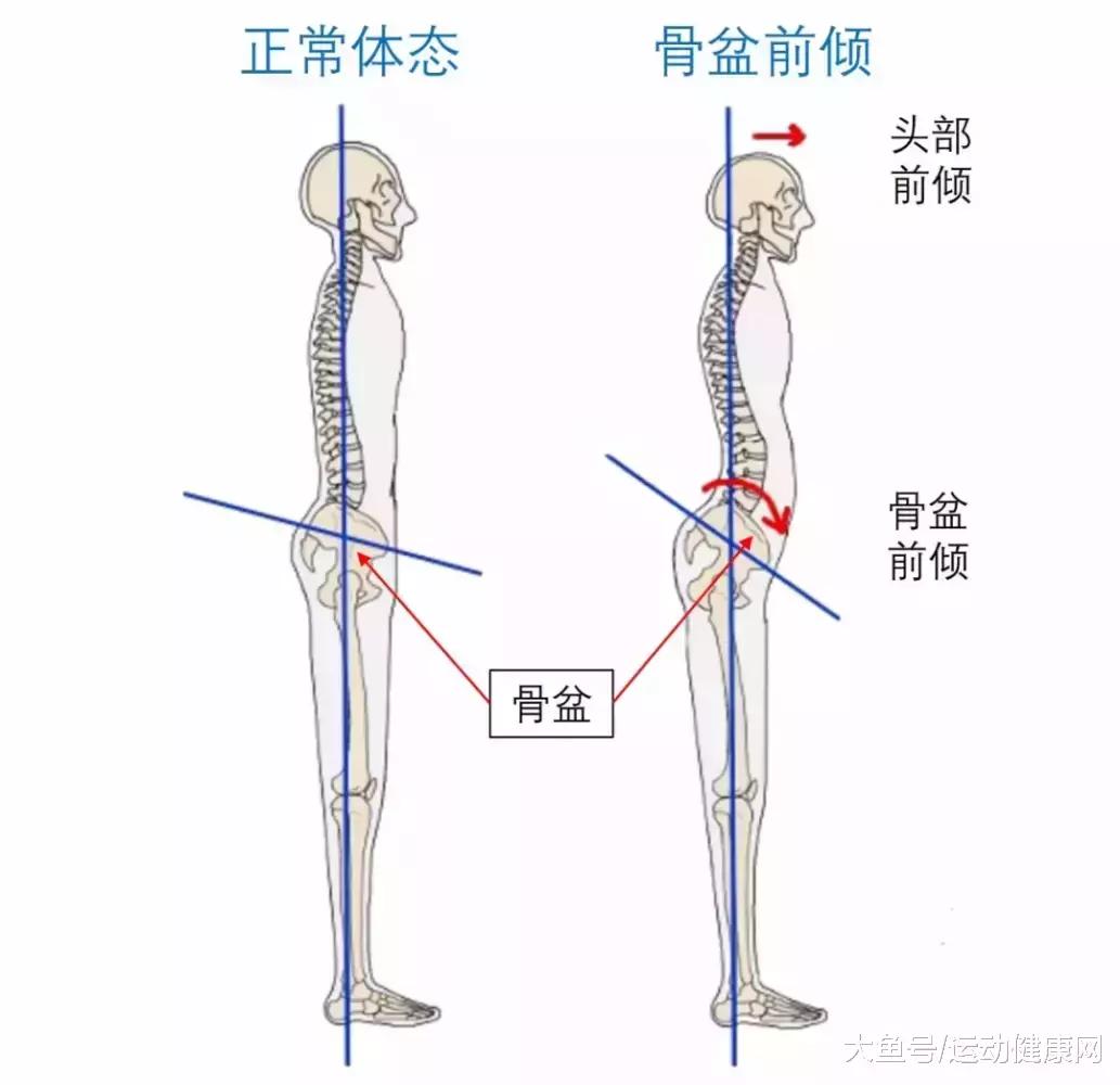 骨盆前倾apt自我修复手册精编