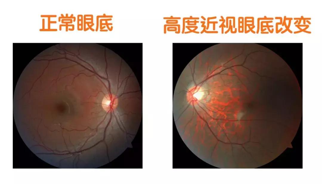 验光只有100度但医生说孩子已是高度近视了