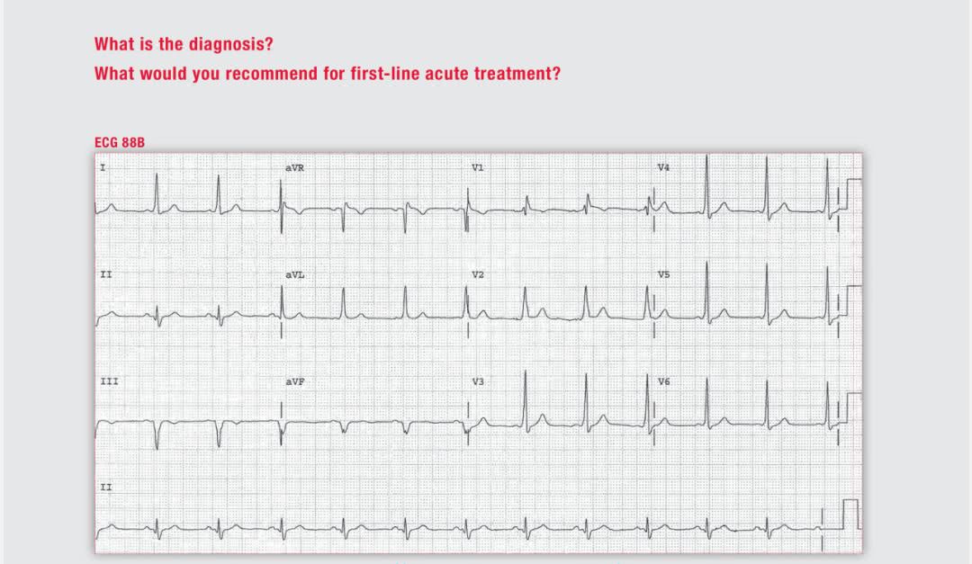 354期:房颤伴预激,如何药物治疗?
