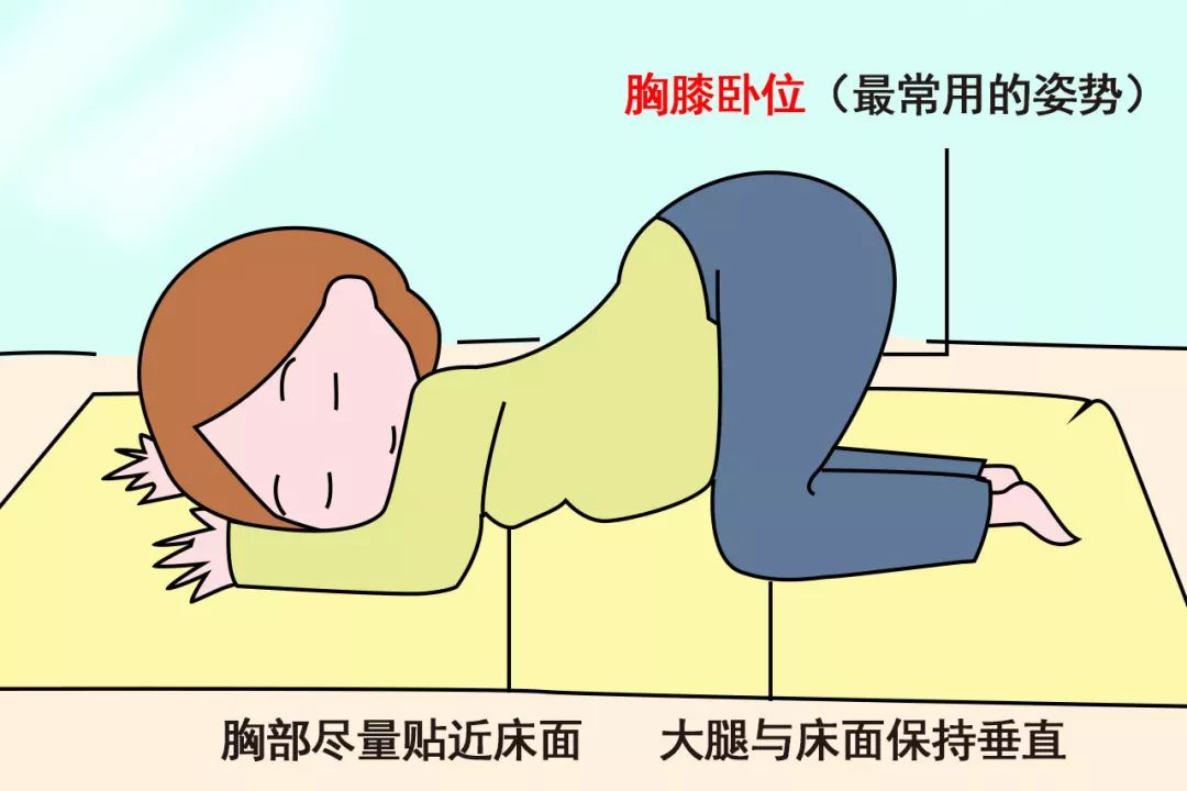 在妊娠28~32周期间,孕妈可以做胸膝卧位操来纠正.
