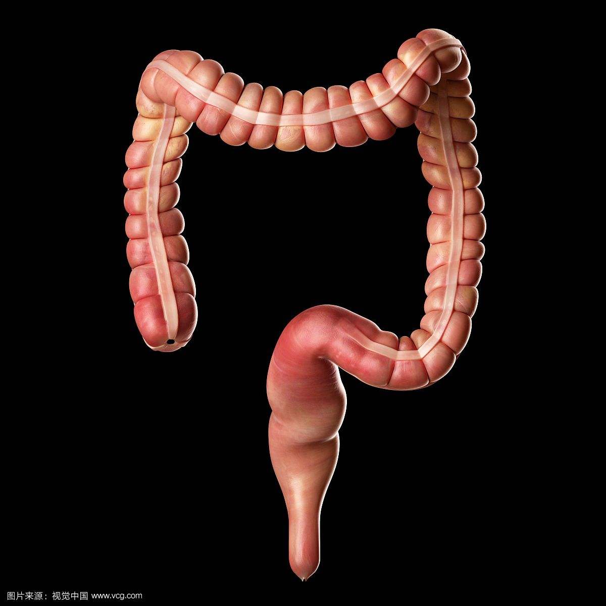 从大肠息肉到大肠癌究竟有多远,三种息肉一定