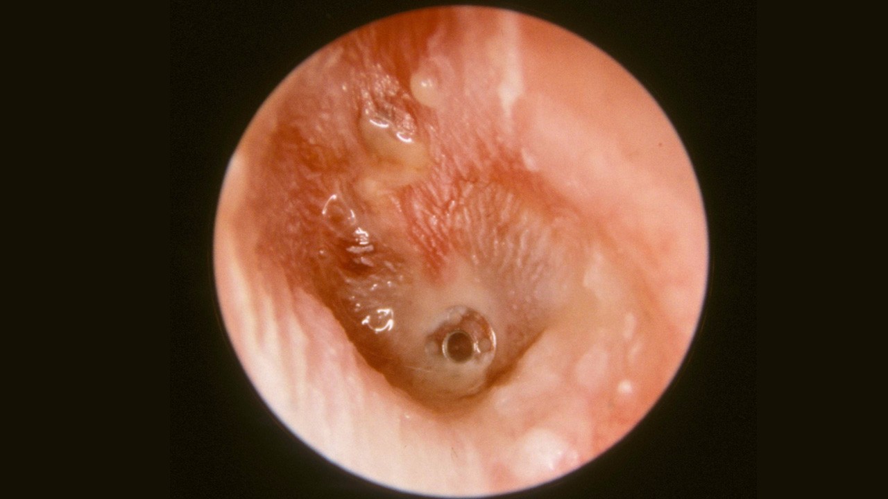 细菌感染引起的中耳炎该怎么治? 健康哥教你艾