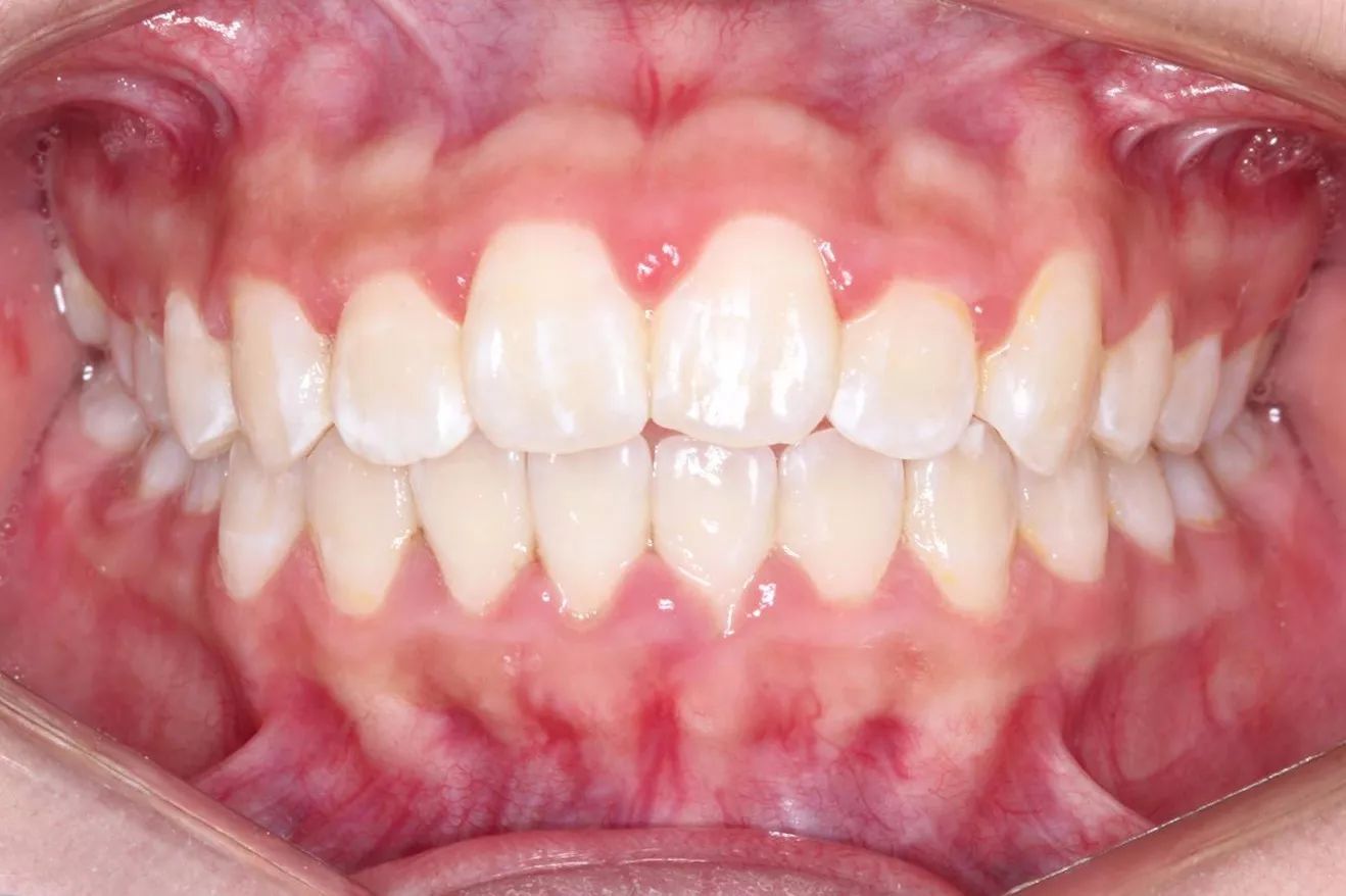 门牙过大,二次矫正,咬合非常不正常|疾病|牙齿|门牙_新浪网