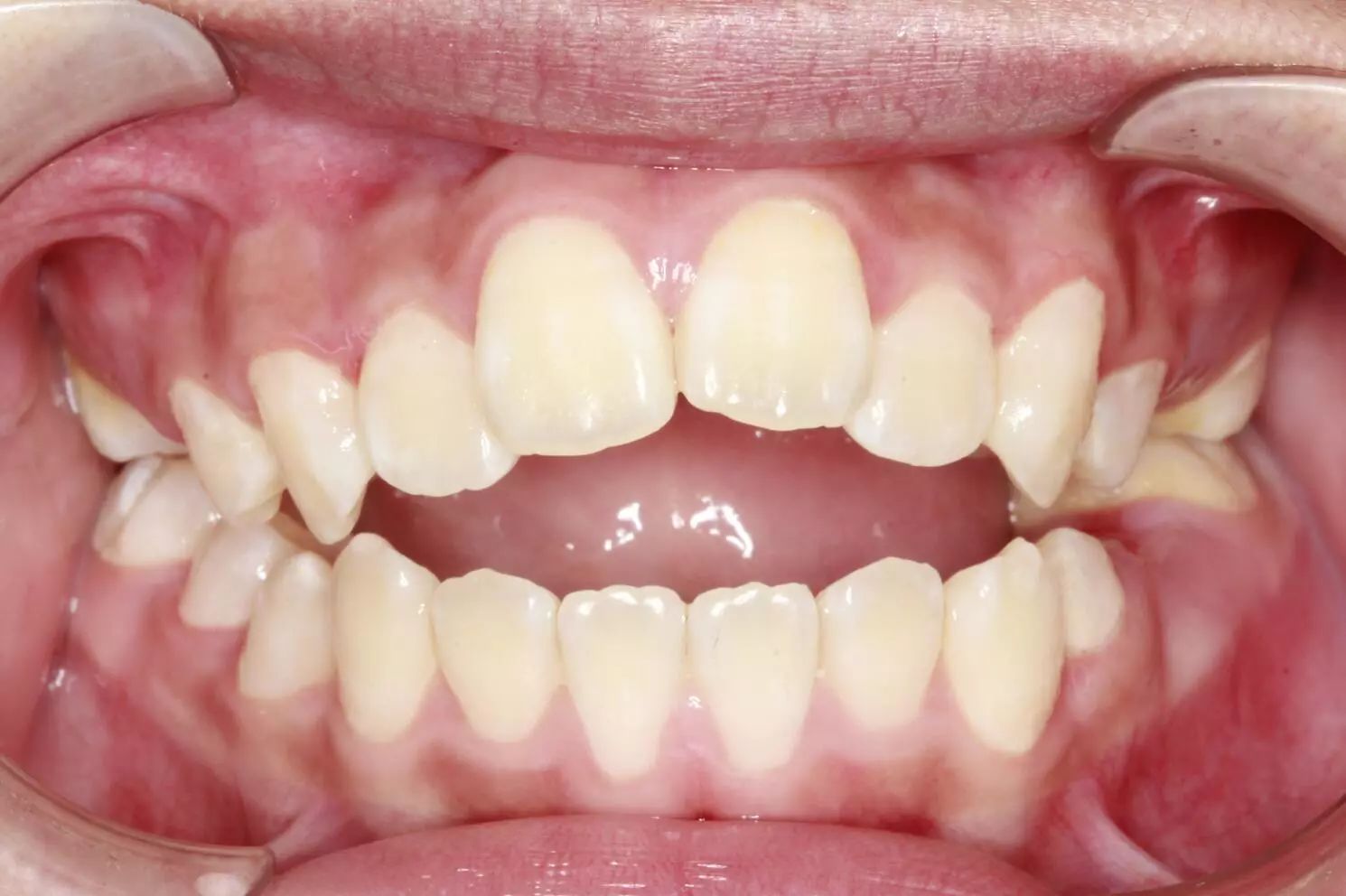 石家庄牙齿矫正郑希医生案例集：门牙对刃、深覆盖、深覆颌深覆盖的正畸案例解析 - 哔哩哔哩