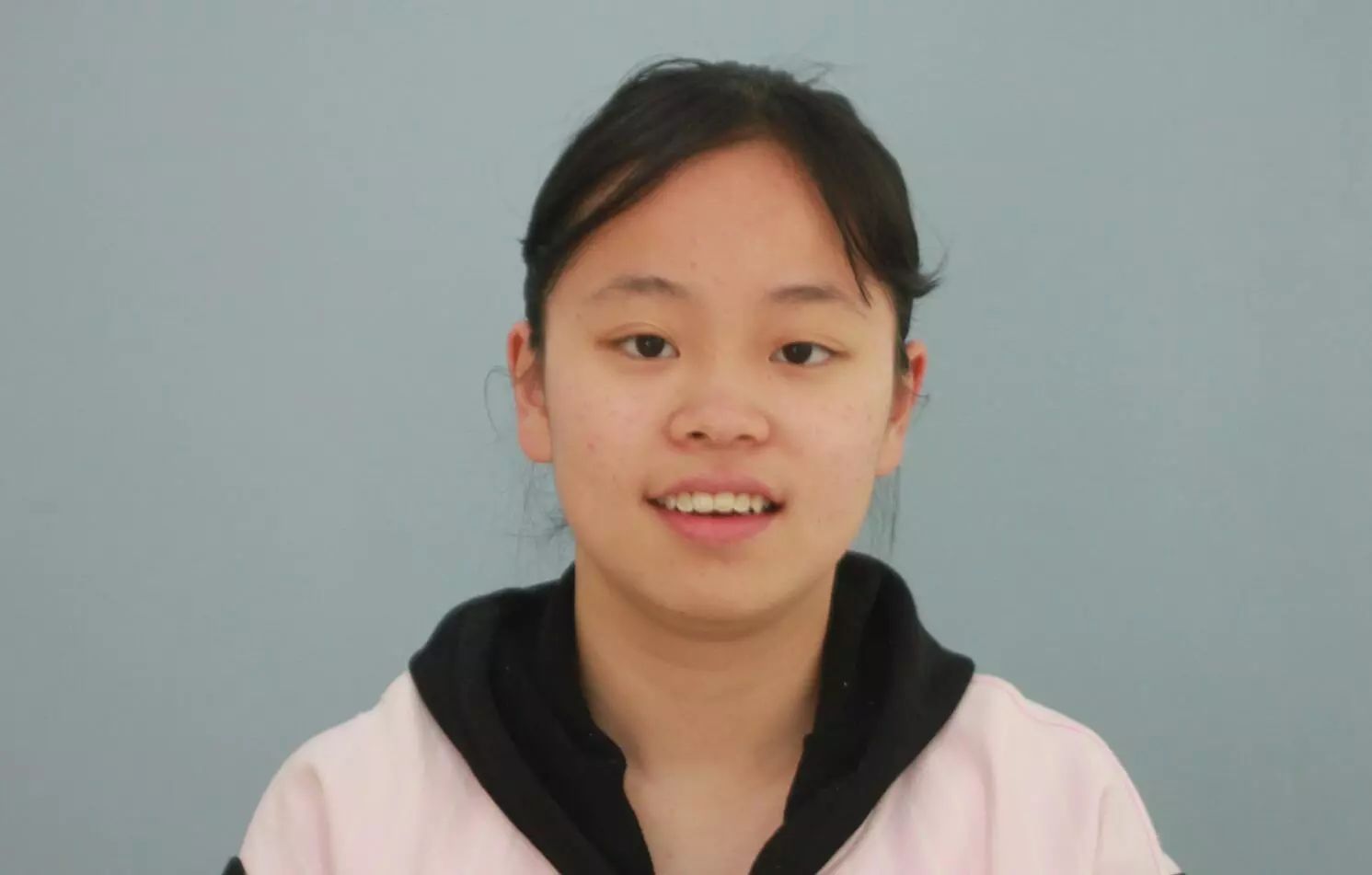 门牙过大,二次矫正,咬合非常不正常