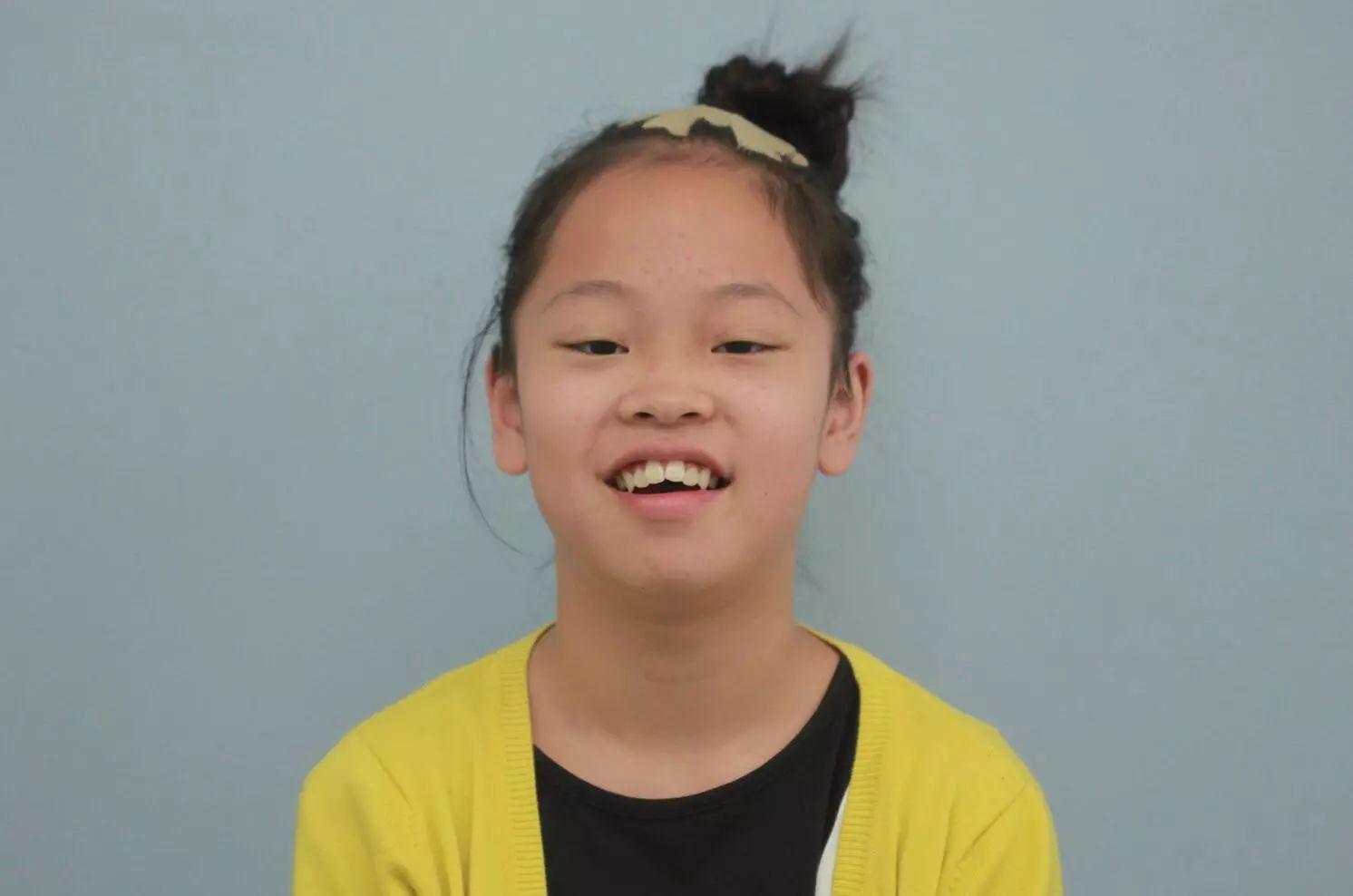 门牙过大,二次矫正,咬合非常不正常