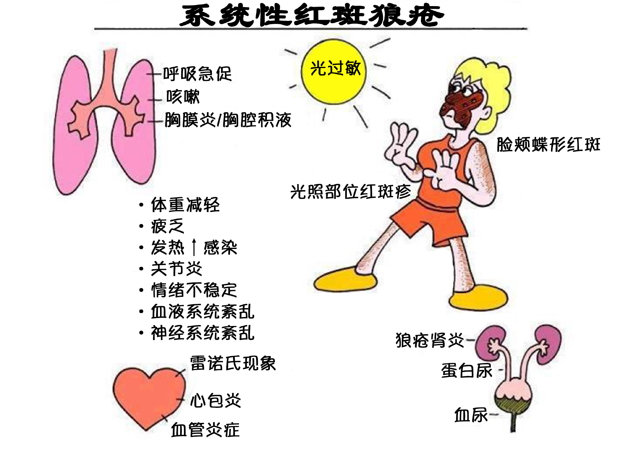 得了系统性红斑狼疮一般可以活多久