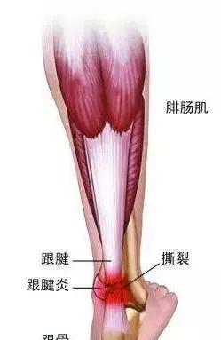 跟腱疼?令刘翔退役的跟腱末端病,究竟怎么康复