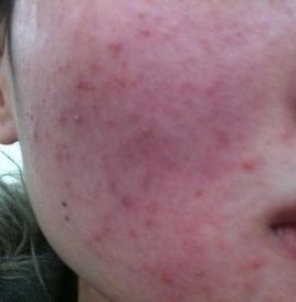 朵嘉浓玫玫;激素脸过敏脸红肿的跟猪头一样怎