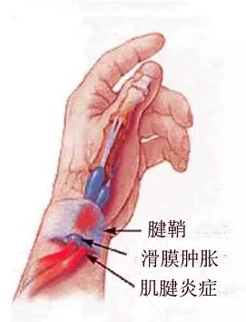 右手大拇指疼的不能弯曲 赵治伟 玩手机玩出了腱鞘炎 腱鞘炎 肌腱 玩手机 新浪新闻