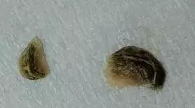 听说牙结石会自己脱落, 别傻了