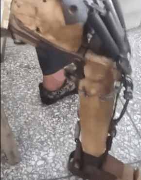 男子自制假腿生活30年, 医院专家见了却这样说……