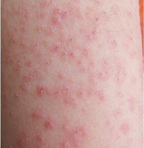 乡间常用一土方,止痒排毒,在家快速告别荨麻疹