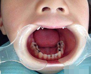 三岁孩子从不吃糖却满嘴烂牙,父母到诊所补牙才发现自己无知
