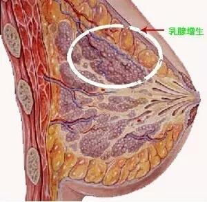 知识科普:乳腺增生 不可小视