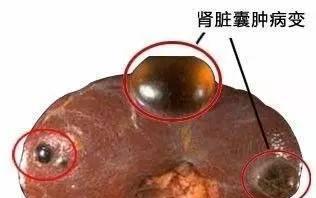 得了肾囊肿不要着急，看了这篇文章就清楚了