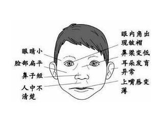 孕妇怀孕饮酒，致孩子患“胎儿酒精综合征”