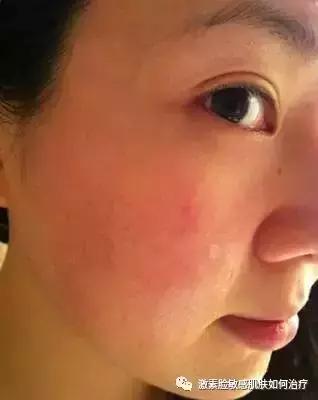朵嘉浓晓晓: 激素脸的治疗, 如何正确区分干敏、